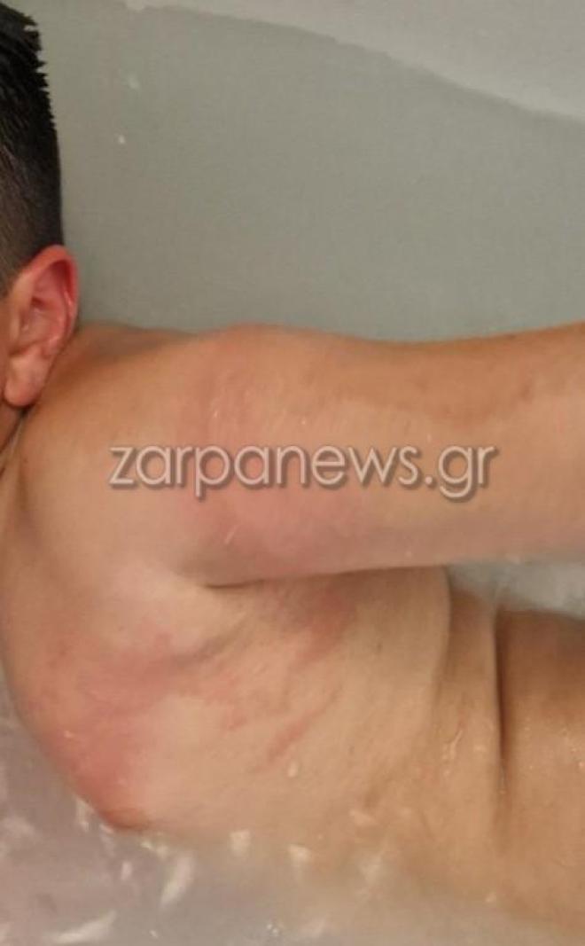 Τσίμπημα παιδιού από θαλάσσια ανεμώνη