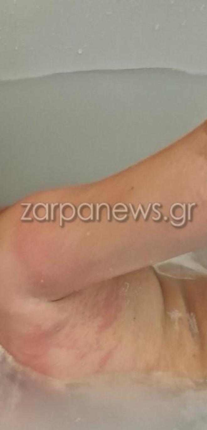 Τσίμπημα θαλάσσιας ανεμώνης