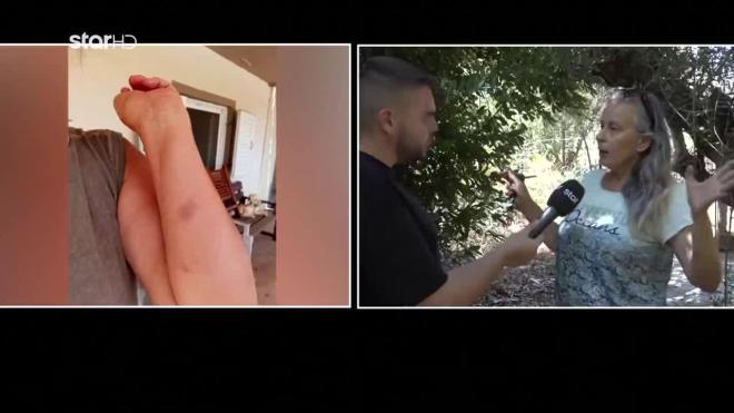 Hλεία: Άγριος ξυλοδαρμός γυναίκας που κατήγγειλε κακοποίηση σκύλων