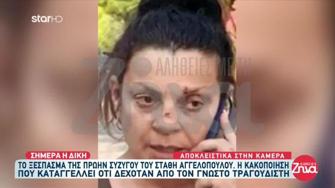H πρώην σύζυγος του Στάθη Αγγελόπουλου με σημάδια στο πρόσωπο
