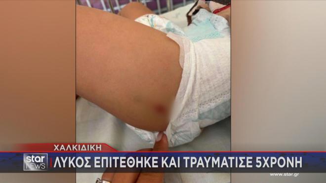 Τα τραύματα στην 5χρονη από την επίθεση λύκου 
