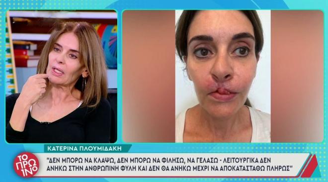 Συγκλονίζει η Κατερίνα Πλουμιδάκη: «Στις 40 εγχειρήσεις θα είμαι καλύτερα»