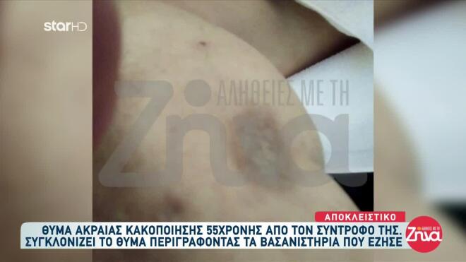 Θύμα ξυλοδαρμού και κακοποίησης περιγράφει τα βασανιστήριά της