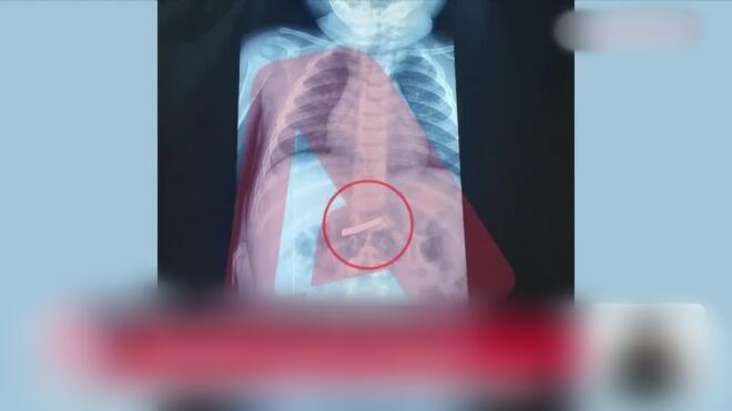 Tρίχρονο παιδί κατάπιε ξυραφάκι