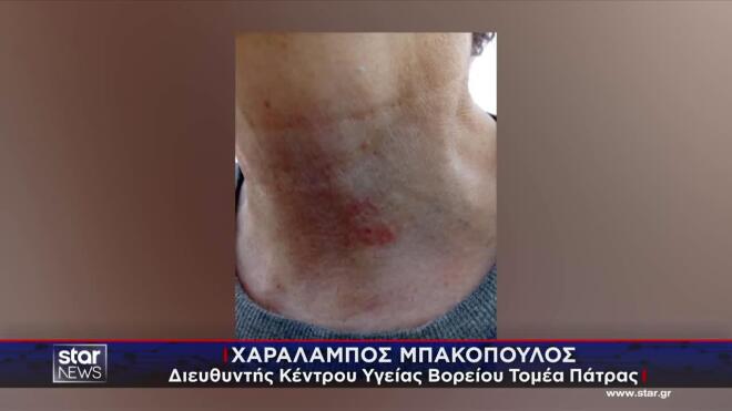 H γυναίκα που ισχυρίζεται ότι τη δάγκωσε λαγοκέφαλος στην Πάτρα