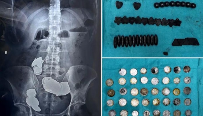 Έφαγε Νομίσματα Και Μαγνήτες Για Το Bodybuilding