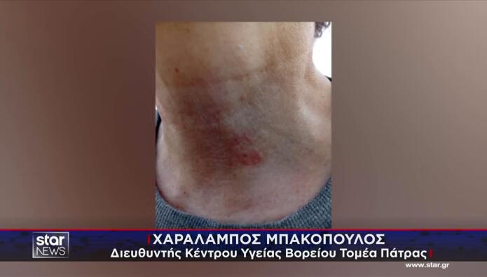Πάτρα: Γυναίκα Ισχυρίζεται Ότι Τη Δάγκωσε Λαγοκέφαλος