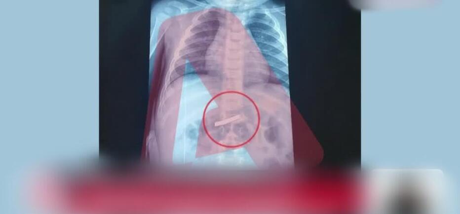 Στο νοσοκομείο 3χρονο παιδί που κατάπιε ξυραφάκι!