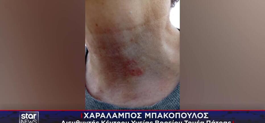 Πάτρα: Λουόμενη ισχυρίζεται ότι τη δάγκωσε λαγοκέφαλος